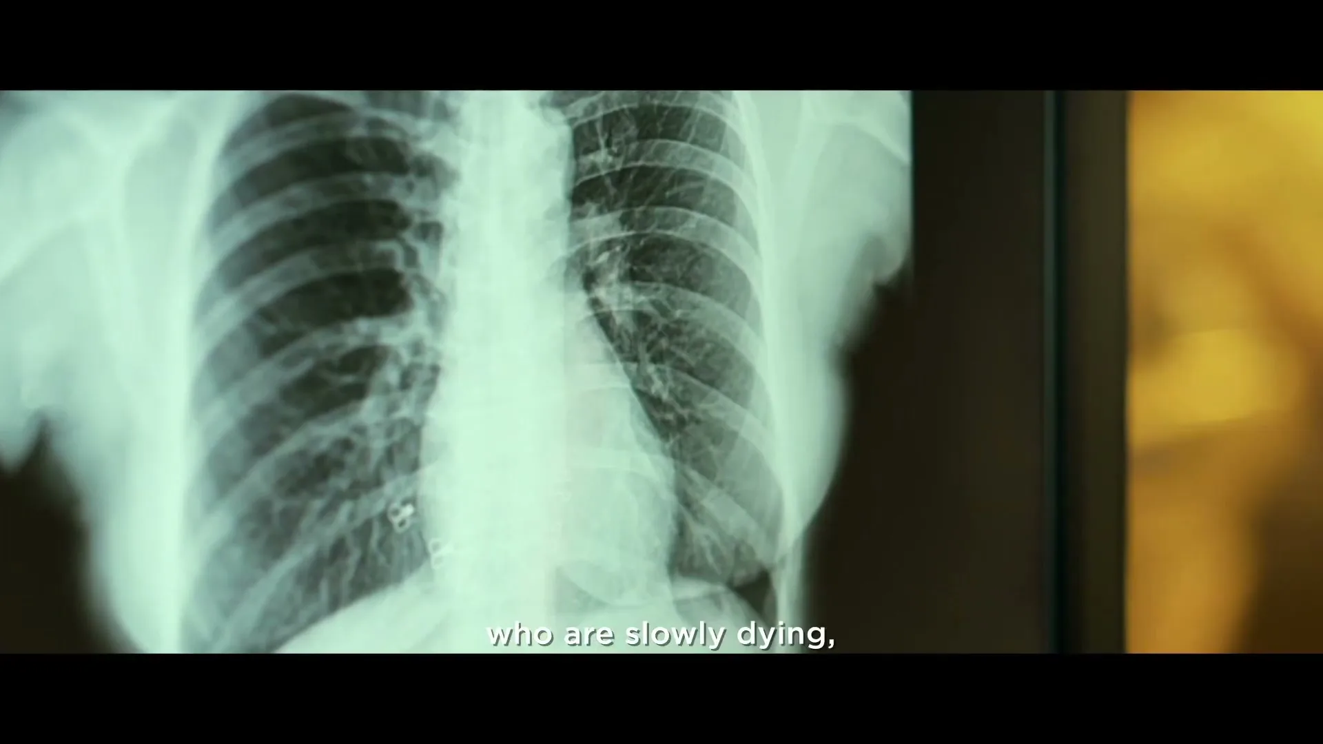 A chest X-ray showing ribs and lungs is displayed, with a blurred background and white subtitles at the bottom of the screen.