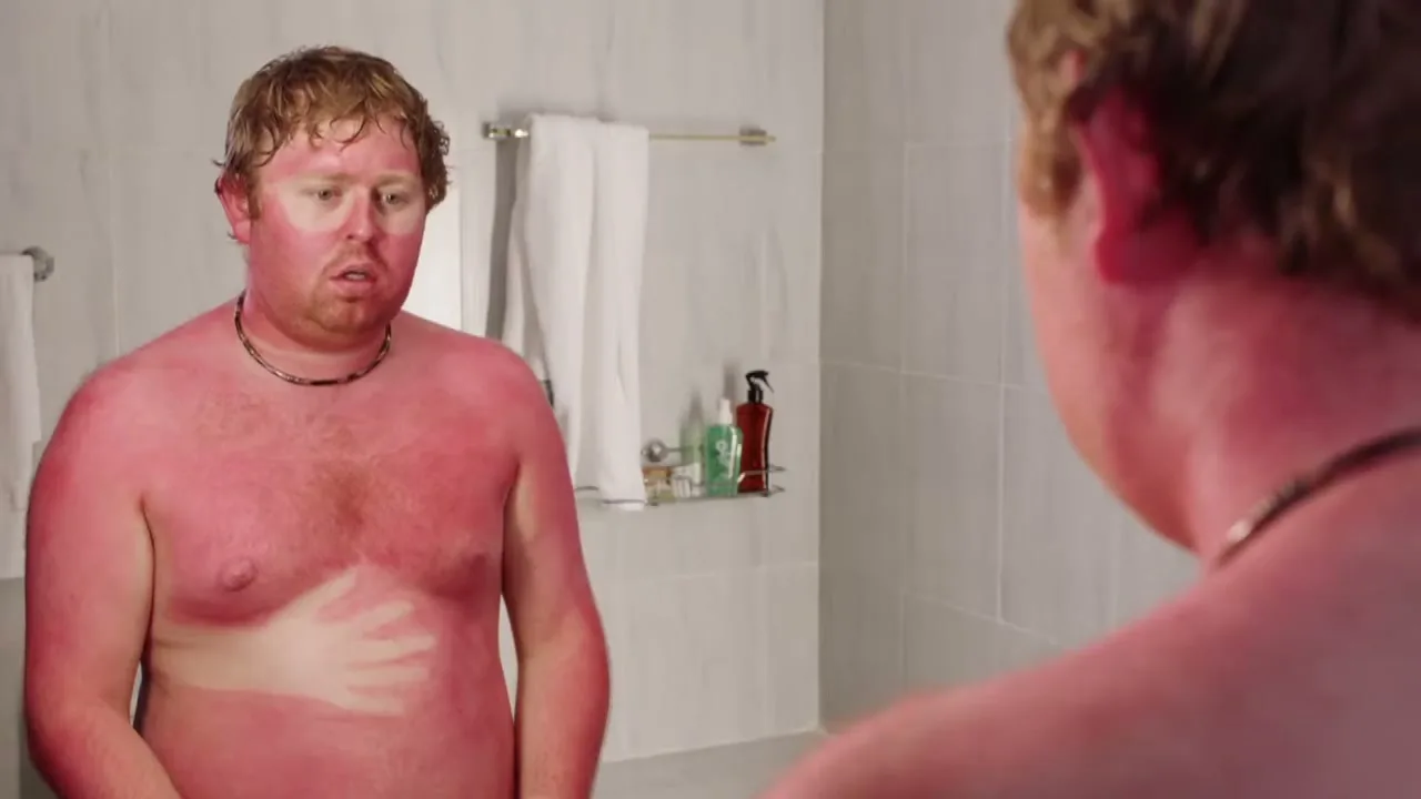 A man with severe sunburn and a pale handprint on his chest looks at his reflection in a bathroom mirror.