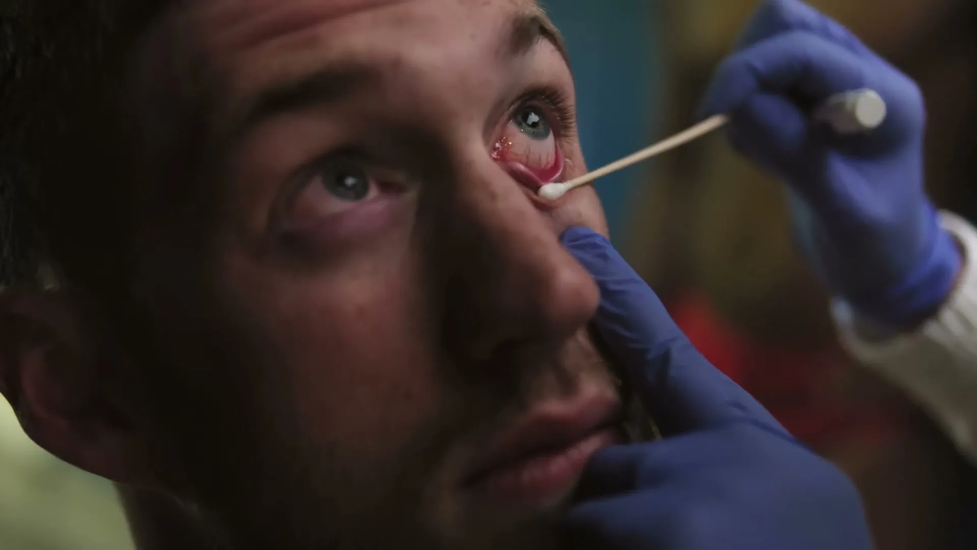 A male athlete with a red, irritated eye looks up as a person in blue gloves gently swabs his lower eyelid with a cotton swab.