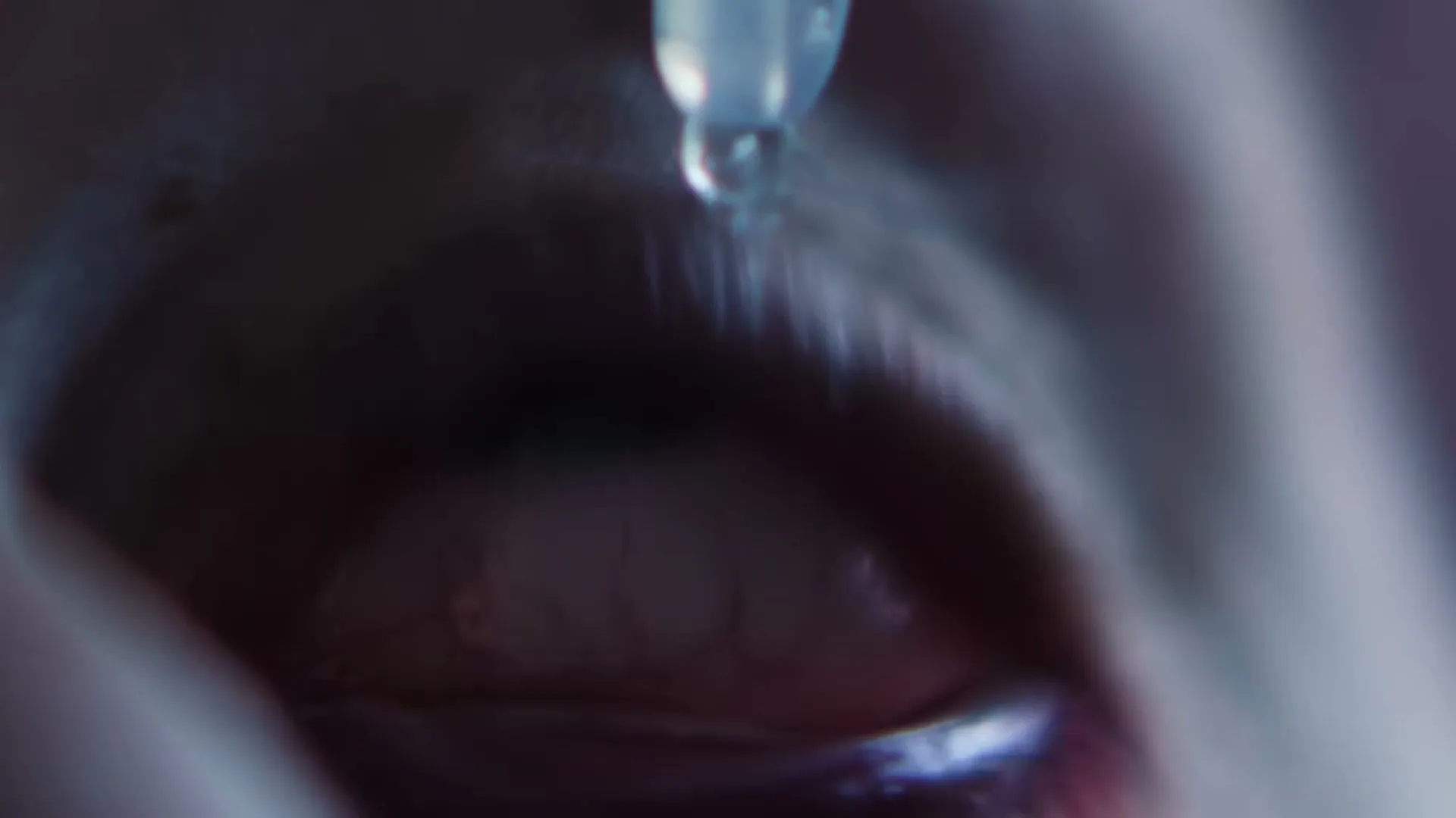 A person's eye is shown in extreme closeup as a drop of liquid falls from an eyedropper into the eye, which is red and veiny.
