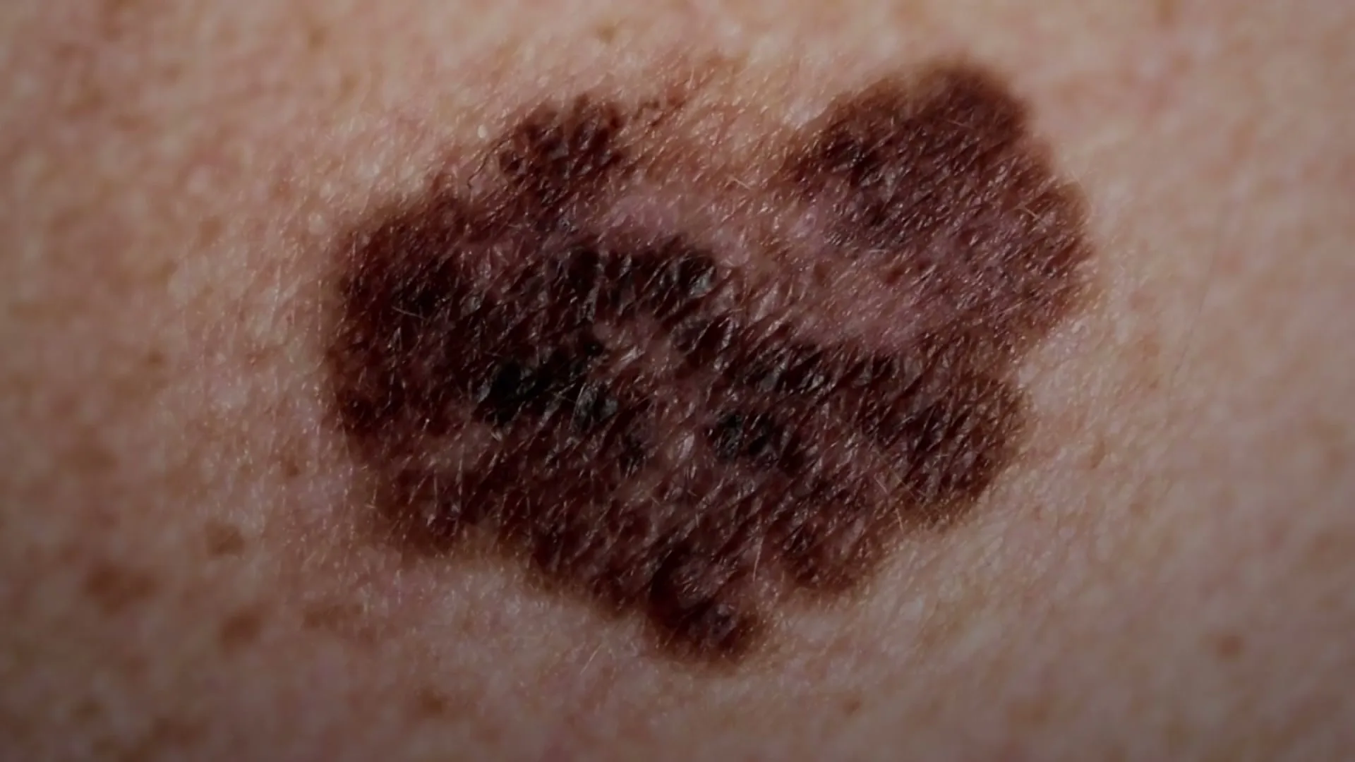 A close-up shot of a dark, irregularly shaped mole on light skin, highlighting its texture and color variations.