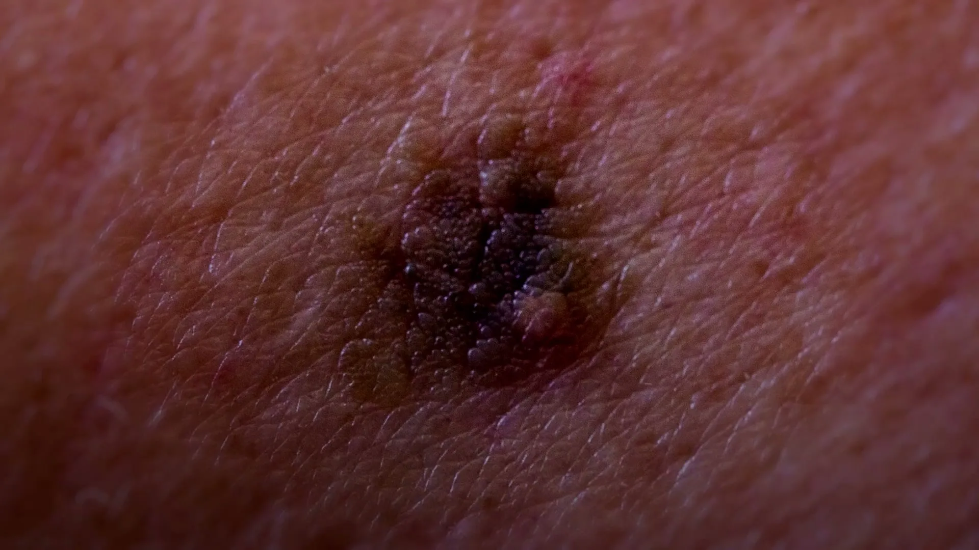 A close-up shot of a dark, irregular mole on human skin, highlighting potential skin cancer.