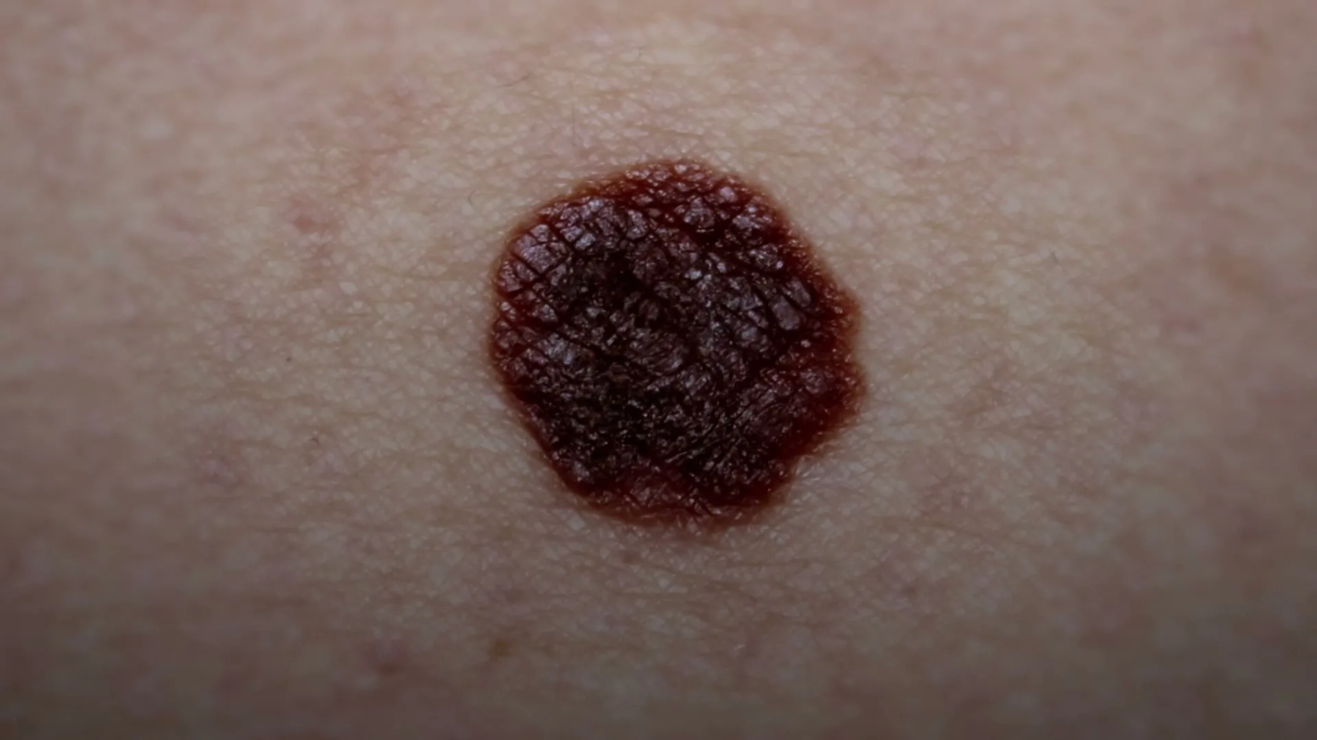 A dark, irregularly shaped mole is shown in extreme closeup on light-toned skin, highlighting its texture and color.