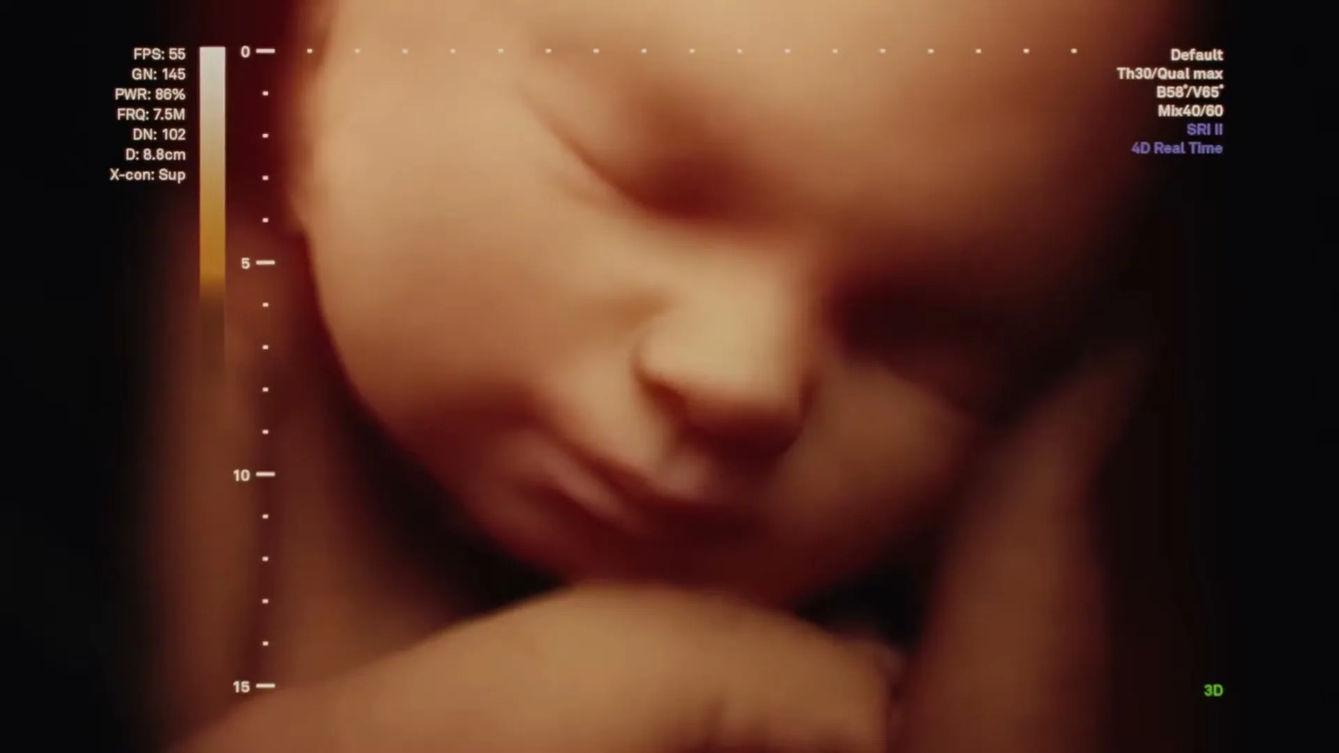 A 3D ultrasound shows a baby's face, eyes closed, with medical data displayed on the left and right sides of the screen.