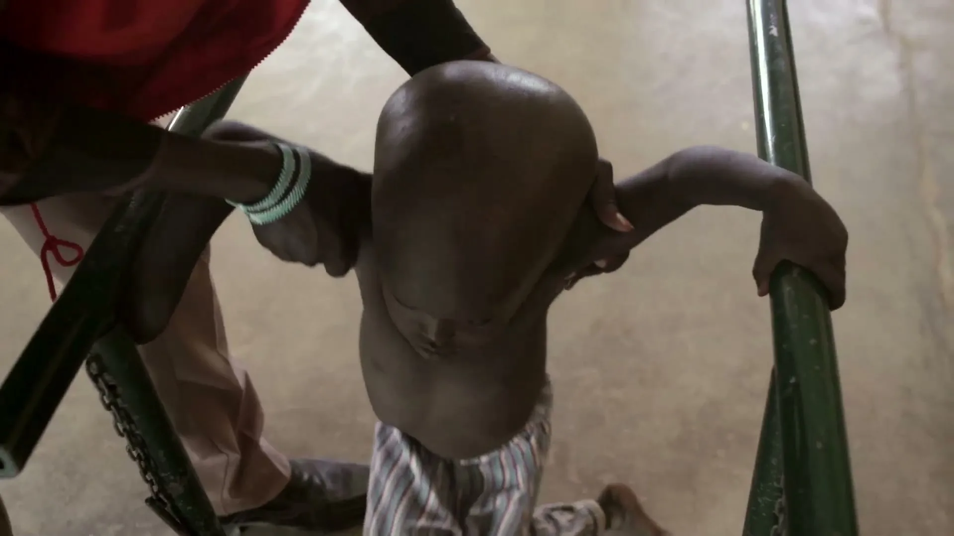 A child with a large head and thin body is helped to stand by an adult's hands, holding onto green bars in an interior setting.