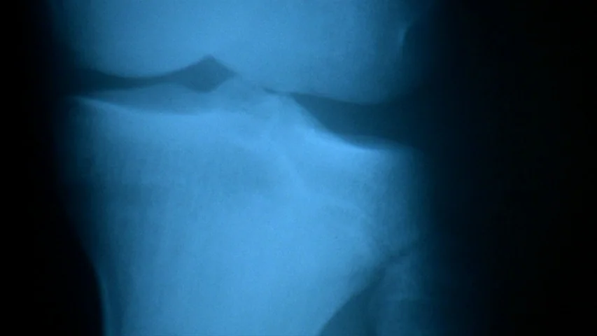 Petulia (1968) movie still: closeup — A close-up view shows a medical X-ray of a human knee joint. The surrounding area remains in deep shadow…